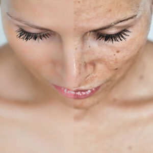 Pigment Removal