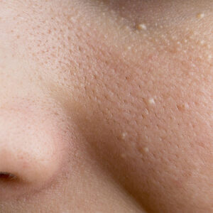Milia Removal
