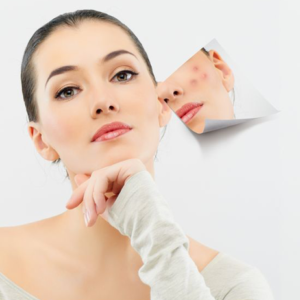 Acne Treatment