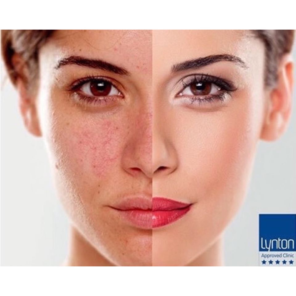 Rosacea