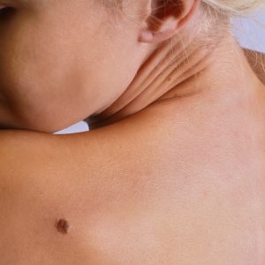 Seborrheic Keratosis