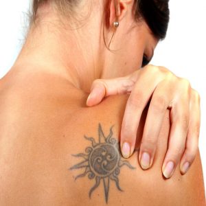 Tattoo Removal