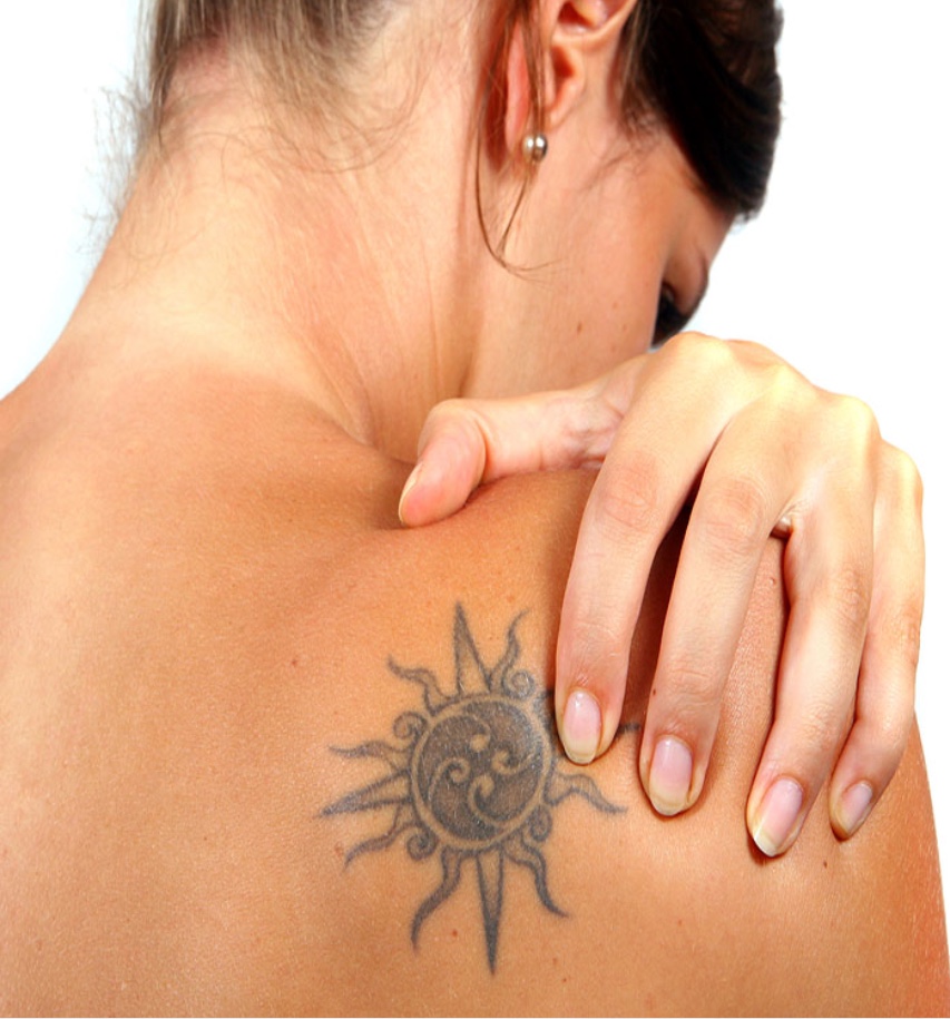 Tattoo Removal