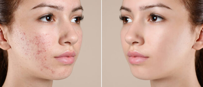 Acne Treatment in Tarleton