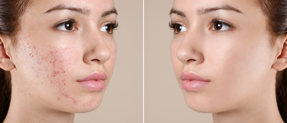 Acne Treatment in Tarleton