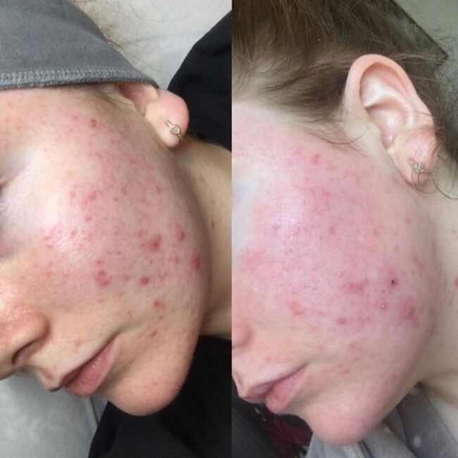 Acne – June 21