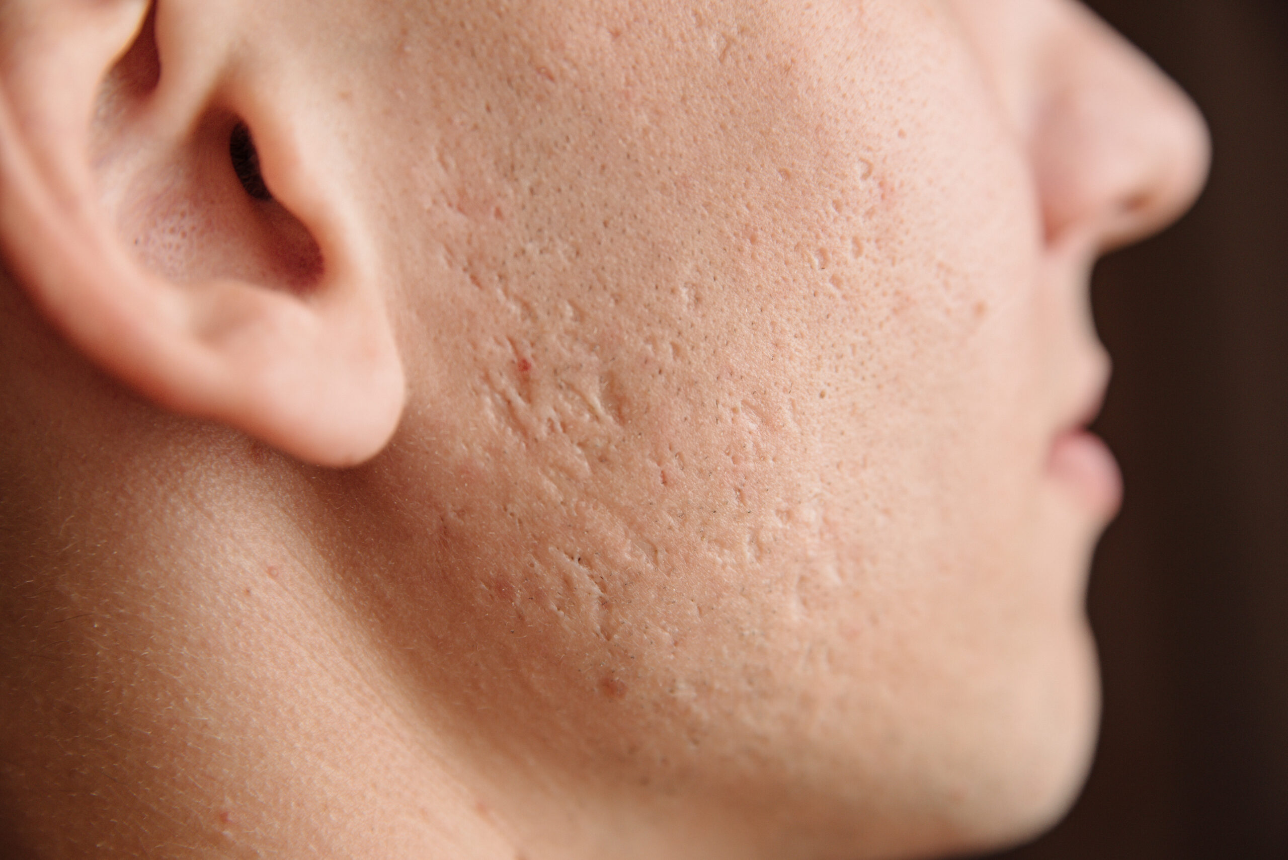 Close-up,Of,Problem,Skin,With,Deep,Acne,Scars,On,A